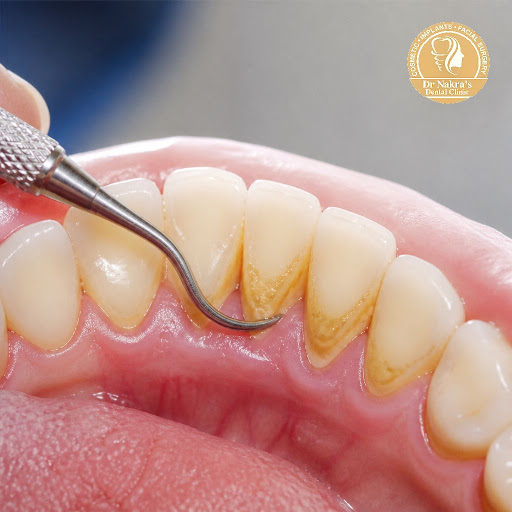 Healthy gums are the foundation of a beautiful smile. At Dr Nakra's Dental Clinic in Surya Nagar,… post image