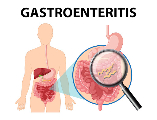 Gastroenteritis, often called a stomach infection or stomach flu, causes inflammation of the stom… post image