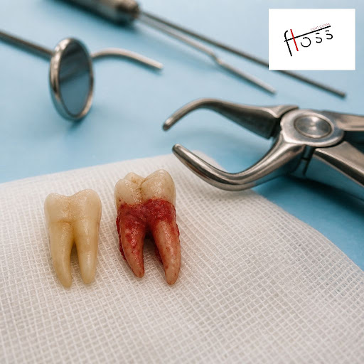 Not all tooth extractions are the same. At Floss Dent Clinik in Andheri West, Mumbai, we explain…