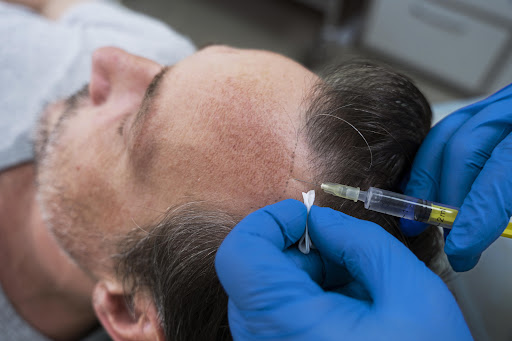 🌟 Our Hair Transplant Services Include: