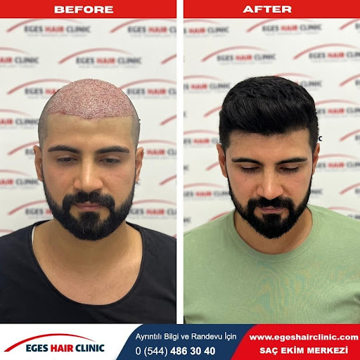 Muğla Saç Ekim Merkezi EGES HAİR CLİNİC