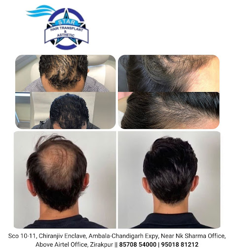 Star Hair Transplant – Best hair transplant in Zirakpur post image