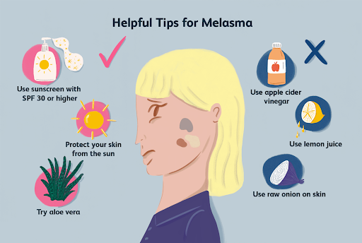 💢 Helpful Tips for Melasma
