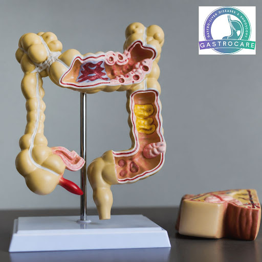 Bile acid malabsorption is a common but often overlooked cause of loose motions, urgency, bloatin… post image