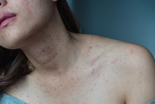 Early evaluation by a Dermatology specialist is important to identify the cause and prevent recur… post image