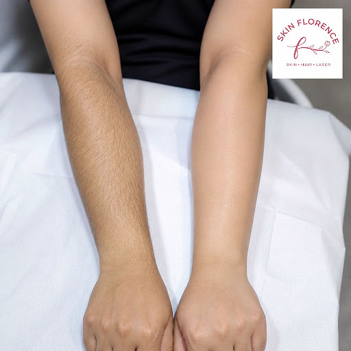 Tired of waxing, shaving and ingrown hair on your arms? At Skin Florence in Wakad, Pimpri-Chinchw… post image