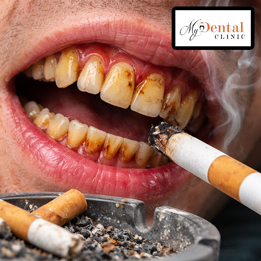 Smoking does much more than stain your teeth. It silently damages your gums, weakens bone support… post image