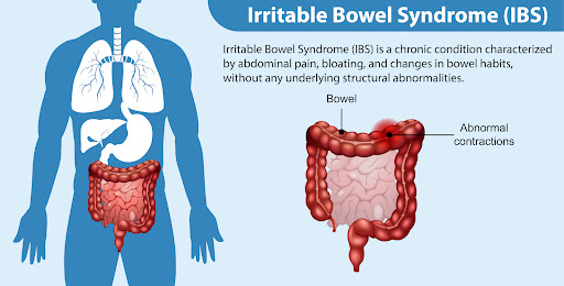 Irritable Bowel Syndrome (IBS) is a common digestive condition that can cause abdominal pain, blo… post image