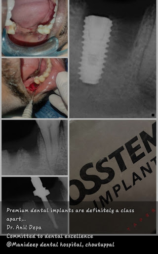Here we are offering dental implants in our hospital... For keeping tummy happy eat well as like… post image