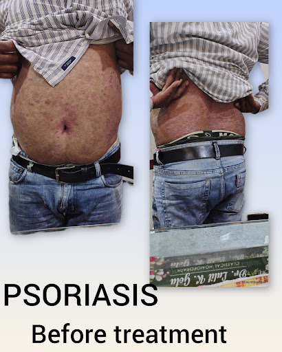 Psoriasis को केवल Skin Disease मत समझिए post image