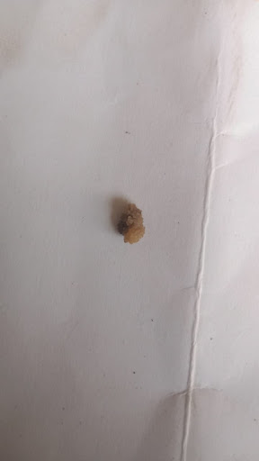 A case of kidney stone (renal calculi) expelled out within 10days post image
