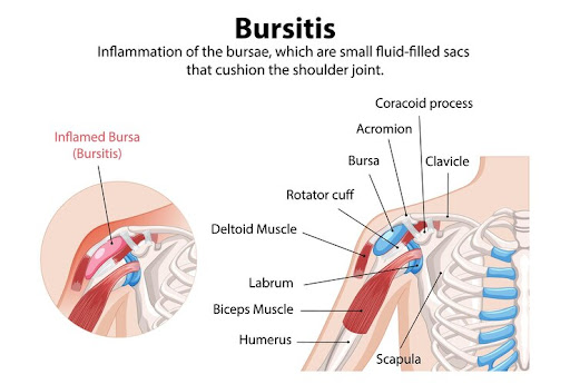 Bursitis is a common condition that causes inflammation of the small, fluid-filled sacs called bu… post image