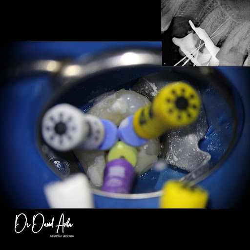 Dr. David Avila - ENDODONCIA - Thumbnail