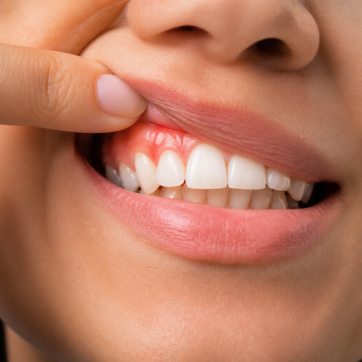 Bleeding gums, bad breath or swollen gums are not normal and may be early signs of gum disease. A… post image