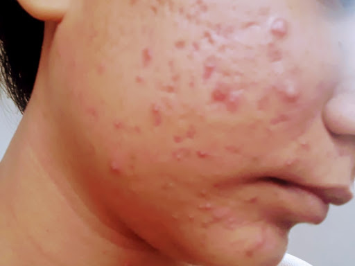 Cured within 2 months (Dr Soumya Dey's Clinic desk)  post image
