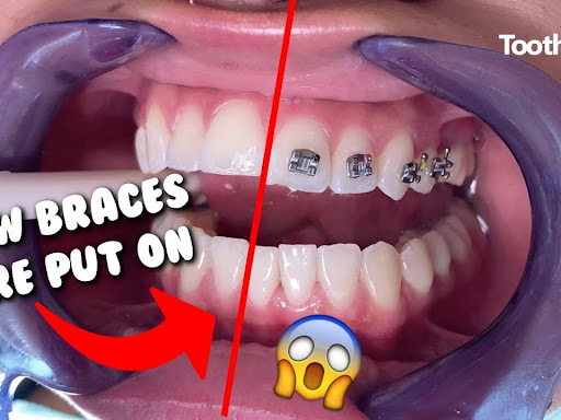 #braces doctor in Gorakhpur, post image