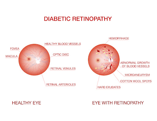 Diabetic retinopathy is a serious eye condition that can develop in individuals with diabetes, po… post image