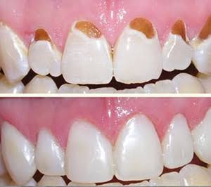 14% off on Cosmetic treatment
