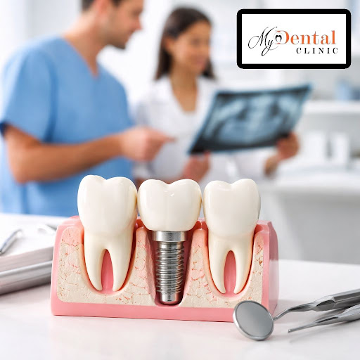 Thinking about replacing a missing tooth? Modern dental implants are one of the most reliable, lo… post image