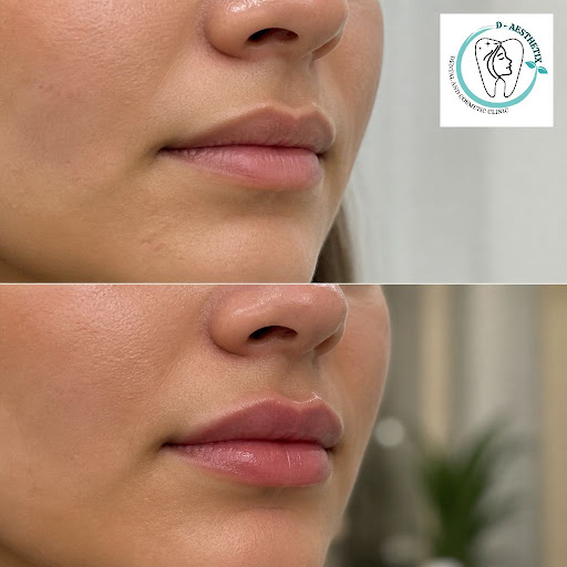 Dreaming of fuller lips without the fake, overdone look? At D-Aesthetix in Trinagar, Delhi, we sp… post image