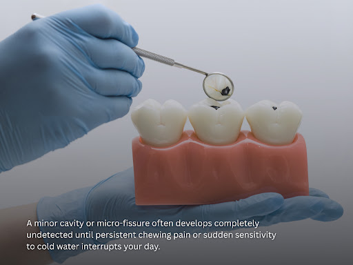 A minor cavity or micro-fissure often develops completely undetected until persistent chewing pai… post image