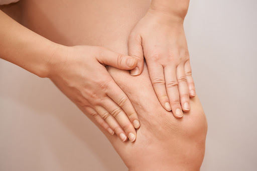 Cellulite is a common skin condition that causes a dimpled appearance, often found on the thighs,… post image