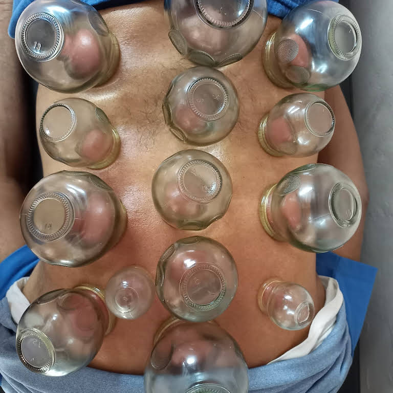 Vijaya Acupuncture & Cupping therapy Centre Acupuncture Clinic in