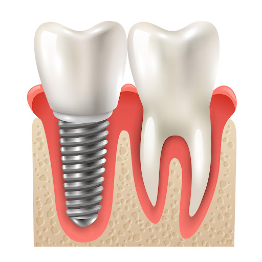 Affordable Dental Implants: What Patients Should Know post image