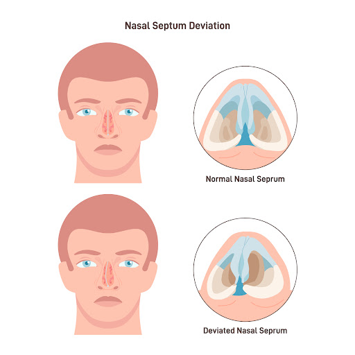 An ENT specialist can evaluate nasal symptoms through a detailed examination and recommend suitab… post image