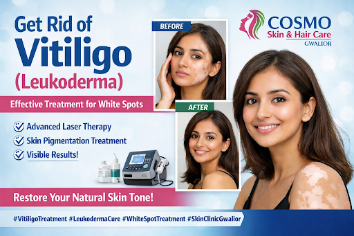 ✨ Vitiligo (Leukoderma) White Spot Treatment in Gwalior ✨ post image