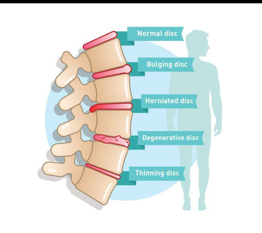 Spinal Disc Issues & Acupuncture: A Healing Touch post image