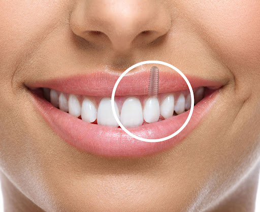 Missing teeth can cause discomfort, difficulty in chewing, and affect your smile confidence. Dent…