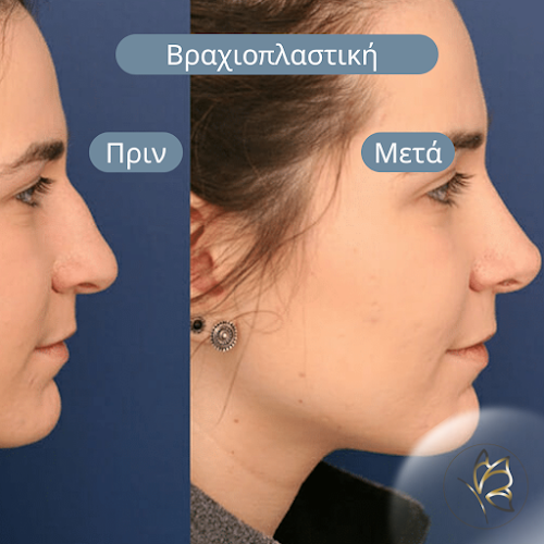 Opinii despre A Plastics - Πλαστικός Χειρουργός - Σαράφης Αλέξανδρος - Τσιμπώνης Αντώνιος - MD, MSc, PhDc, FEBOPRAS în Ωραιόκαστρο - Γιατρός