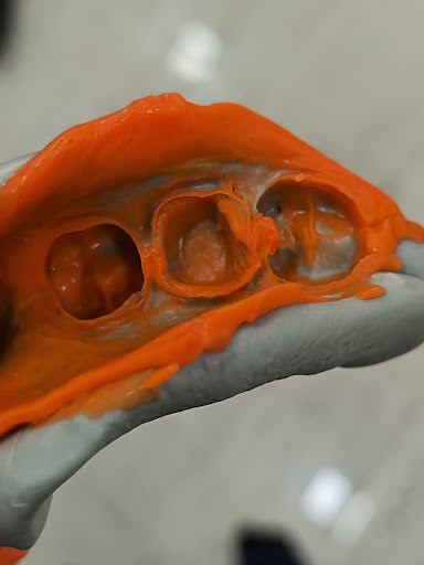 Opfing for elastomers over alginate impressions. Elastomersoffer superior accuracy, detailsand du… post image