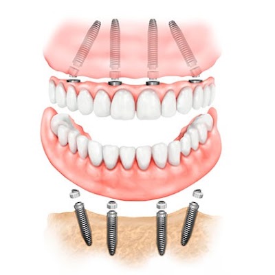 Dental Care - Klinika Dentare "Dental Care" - Klinike Dentare Durres