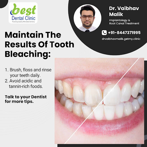 Tooth whitening is either the restoration of a natural tooth shade or whitening beyond the natura… post image