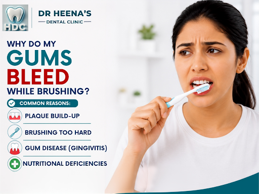 Have you noticed your gums bleeding while brushing? It might seem like a small issue, but it's of… post image