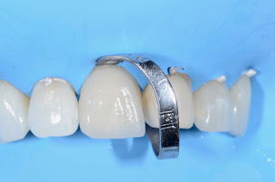 Photo n°10 de Docteur Romain RUITORT Esthétique Dentaire à Nice (Parodontiste spécialiste des implants dentaires)