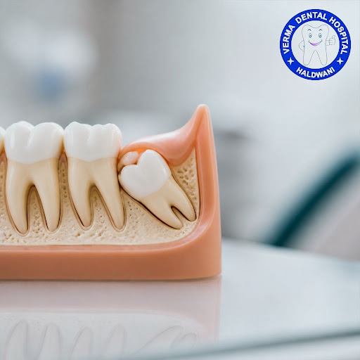 Painful or swollen wisdom tooth troubling you again and again? Delaying wisdom tooth removal can… post image