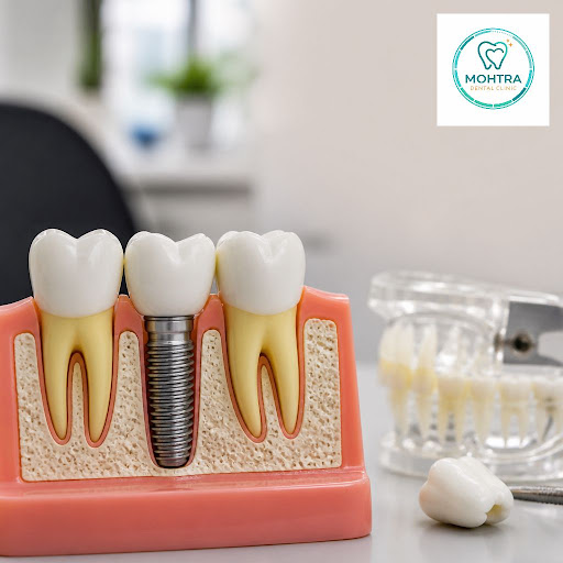 Thinking about replacing a missing tooth but not sure how dental implants actually work? At Mohtr… post image