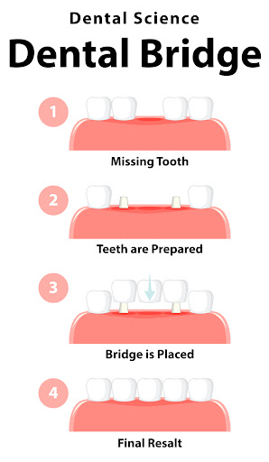Understanding Implant-Supported Bridges for Restored Function and Smile post image