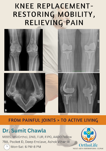Severe knee arthritis can cause constant pain, stiffness, and difficulty in walking. For patients…