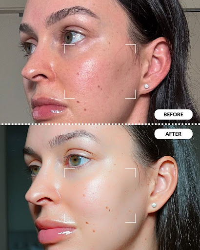 BestCosmetologistInMansarover

#LUMINASKIN&AESTHETICCLINIC #