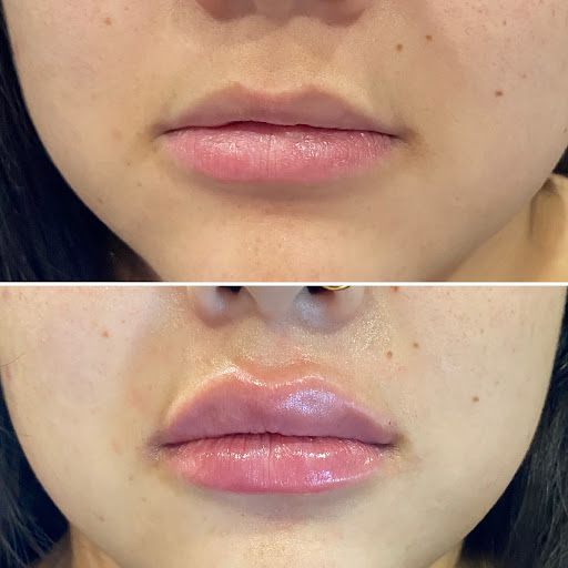 Flawless Faces MedSpa Chandler Botox, Lip Fillers And Laser Hair Removal