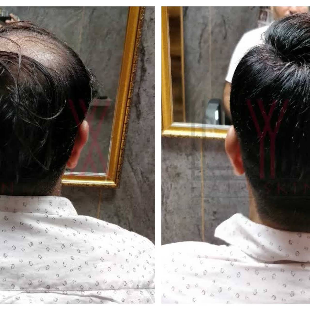 Hair Patch in Gurgaon, Hair Bonding in Gurgaon, Wig Shop Wig Shop in