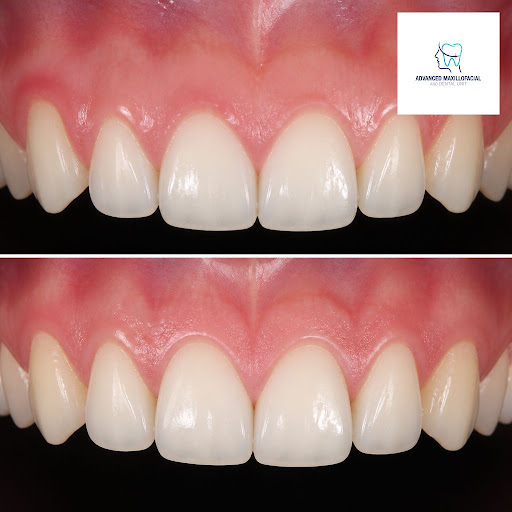 If you’ve been told you have a gummy smile, short teeth, or a tooth broken near the gumline, crow… post image