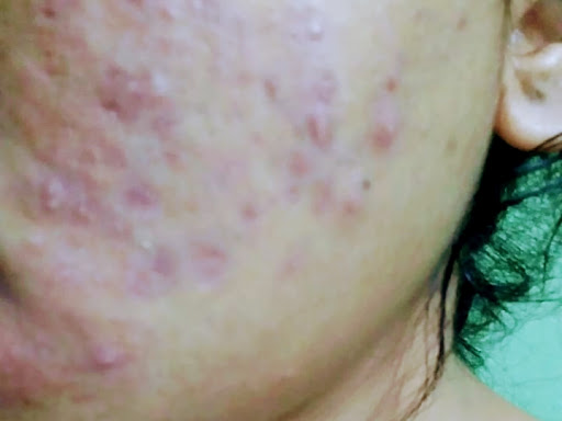 Cured within 1 month (Dr Soumya Dey's Clinic desk)  post image