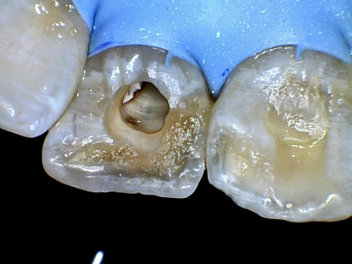 Treatment is performed by MDS Prosthodontist from KGMU using modern equipment for precise and com… post image