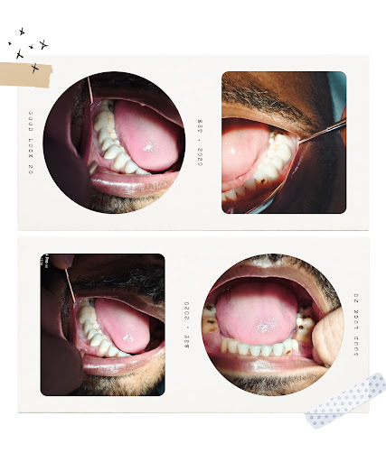 Fixed prosthesis