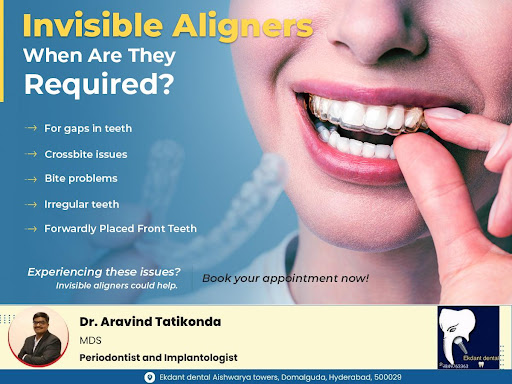 Invisible Aligners: When Are They Required? post image